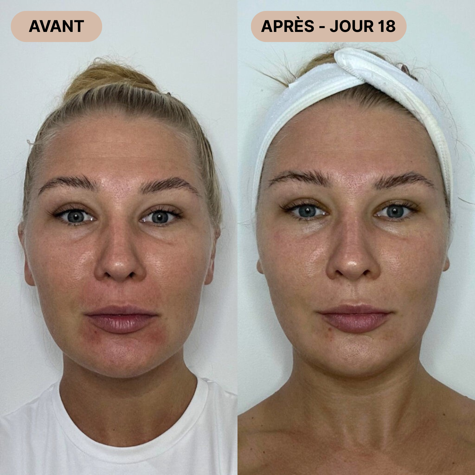 FaceLift Pro™